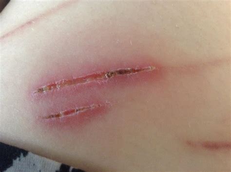 Is my cut infected or just healing?