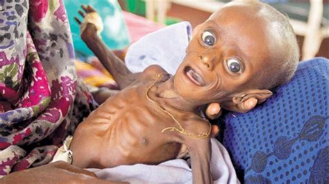 Number of Malnourished Children in Somalia Rose 40% in Feb | Business ...