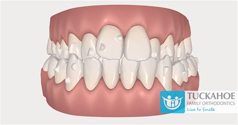 If Invisalign is Supposed to Be Invisible, What Are These Attachments For?