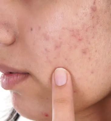 Diagnosis And Treatment Of Acne Scars | Schweiger Dermatology Group