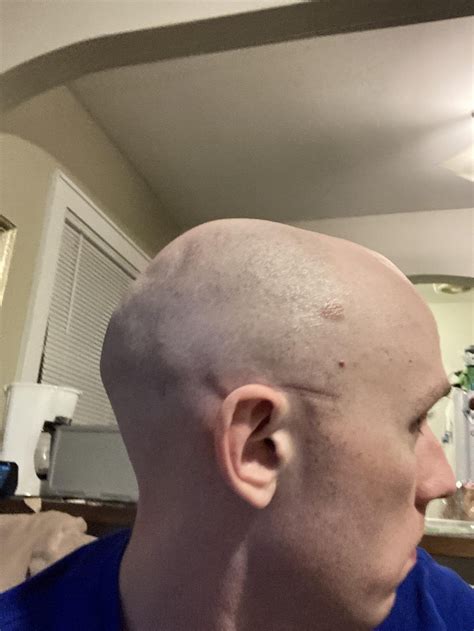 Shaved my head and noticed some dents/lumps on my skull, also my entire ...