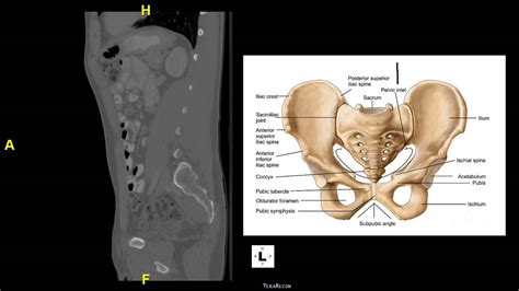 Sagittal CT of Pelvis and Lumbar Spine - YouTube