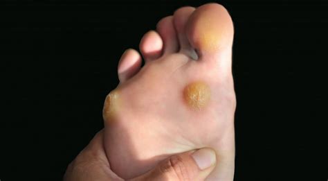 What to Do About a Corn: Errol Gindi, DPM: Podiatrist