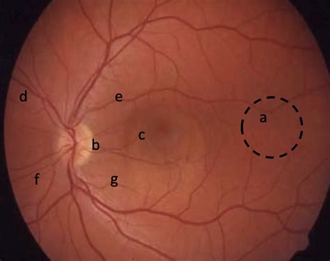 Fundoscopy - Oxford Medical Education