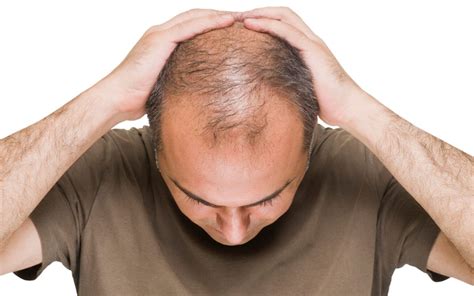 What causes male pattern baldness - superliving