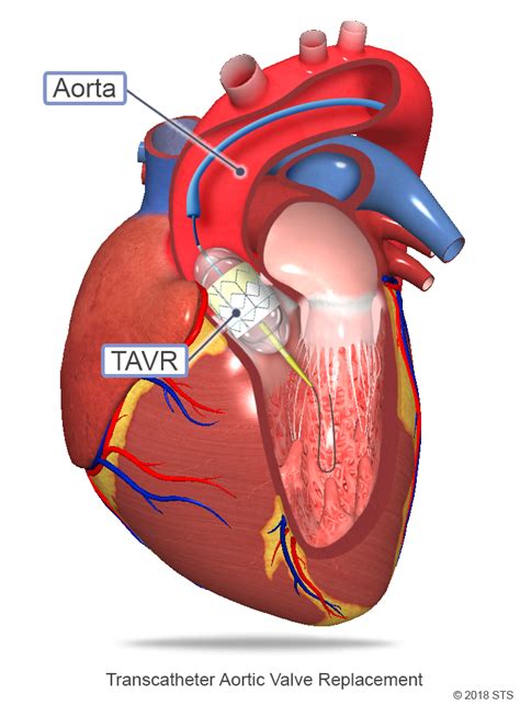 Aortic Valve Disease | The Patient Guide to Heart, Lung, and Esophageal ...