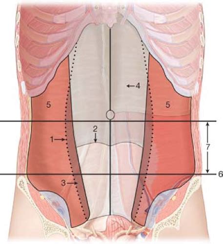 Linea Semilunaris Hernia