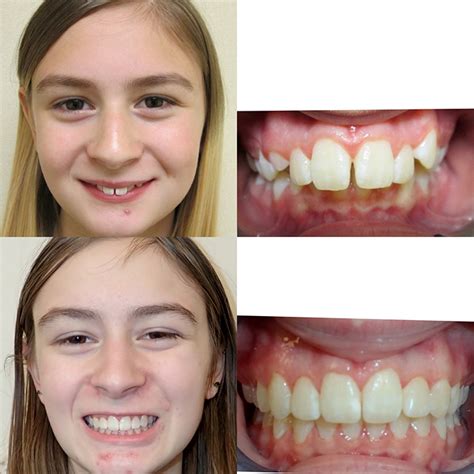 Before And After Braces Overbite