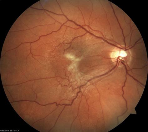 Epiretinal Membrane | Retina & Vitreous of LA