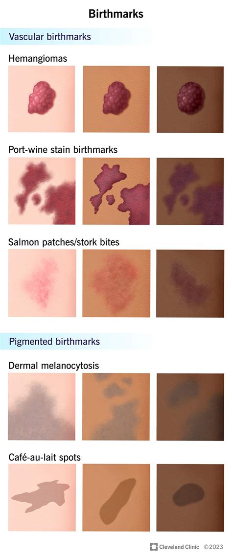 Birthmark Causes & Treatments