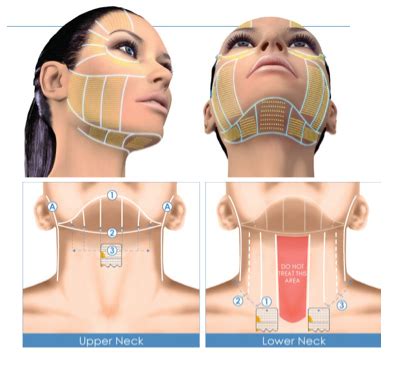 Ultherapy – Face Lift – Ultherapy treatment in Ontario