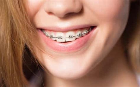 Ceramic Braces – Complete Guide with Pros Cons & All Information (2022)