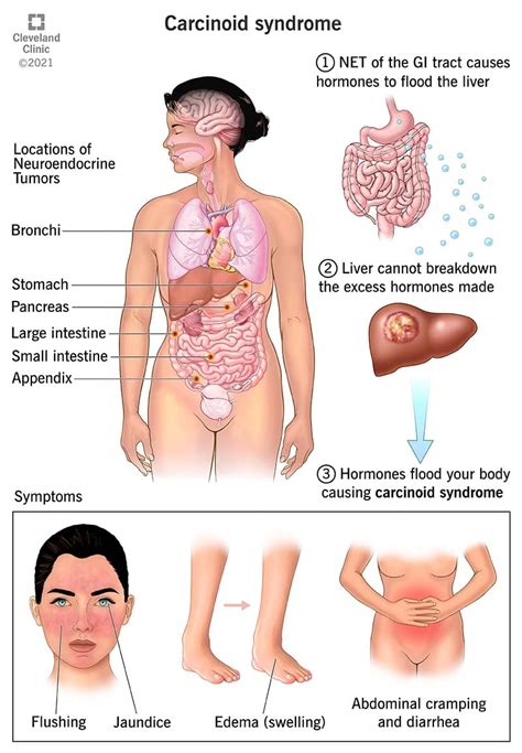 Managing Carcinoid Syndrome: Tips And Strategies - Ask The Nurse Expert