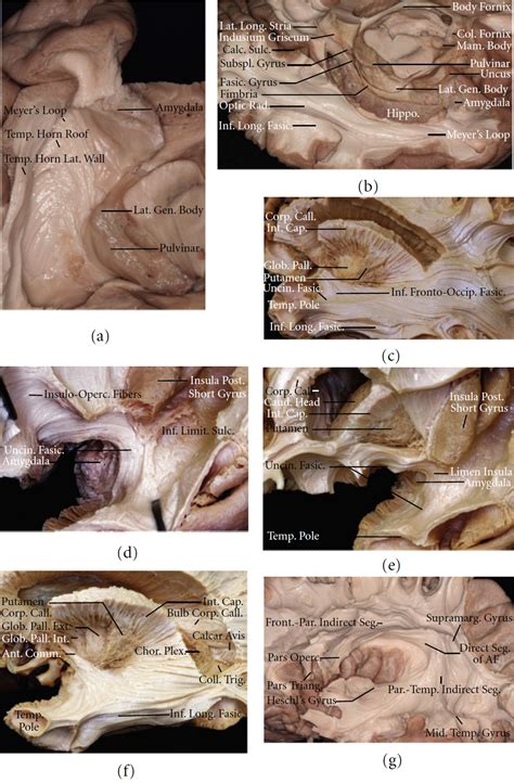 Views of the Temporal Horn and Temporal Subcortical Structures ...