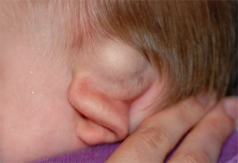 Glial Choristoma of the Temporal Bone in a 7-Month-Old Infant ...