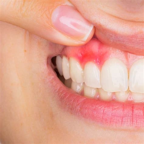 Gum Abscess Pictures - Gum Abscess Photograph By Science Stock ...