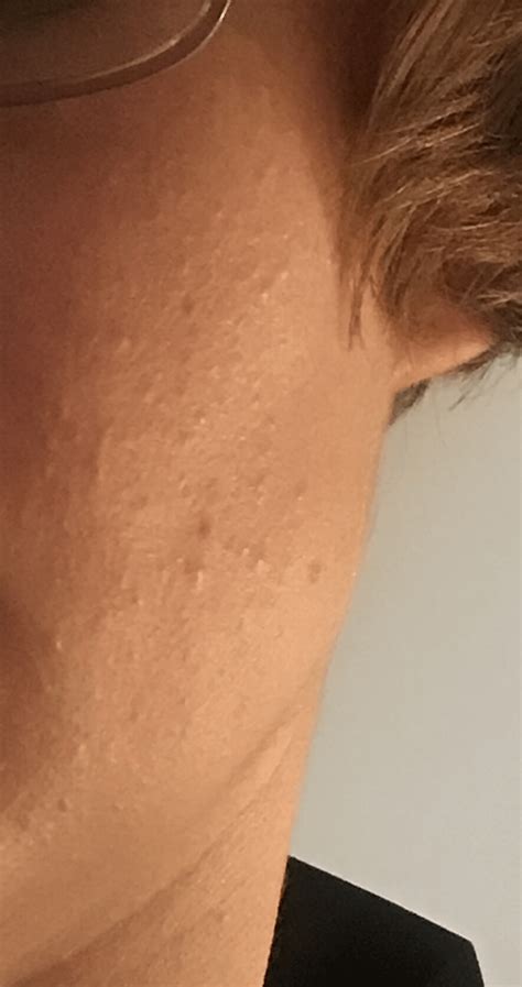 [skin concerns] Damaged moisture barrier? : r/SkincareAddiction