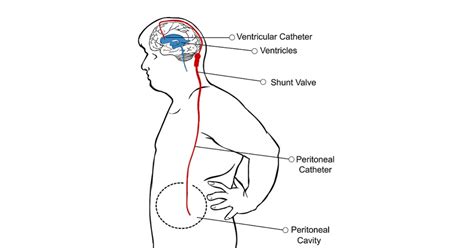 Best VP Shunt Doctors & Hospitals in India