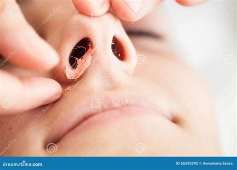 Nasal Hair-removal with Hot Wax Stock Photo - Image of retreat, face ...