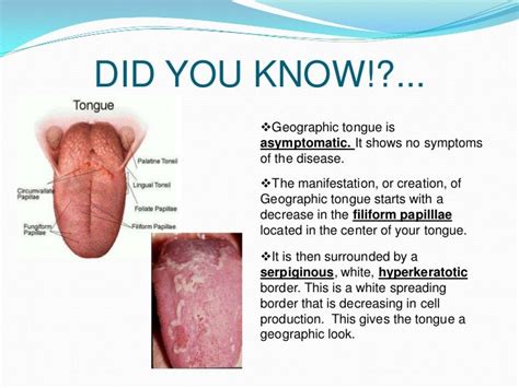 Geographic tongue disease powerpoint