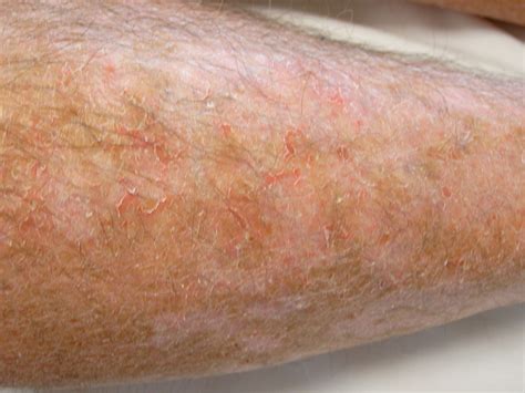 Surichinmoi Máxima protestante scaly skin patches on legs Afirmação ...