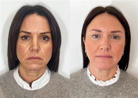 Fillers Before and After | The Cosmetic Skin Clinic