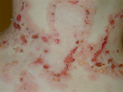 epidermolysis bullosa pictures - pictures, photos