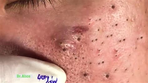 Newest Blackhead Removal Videos 2024 – Youtube - Eula Laurella