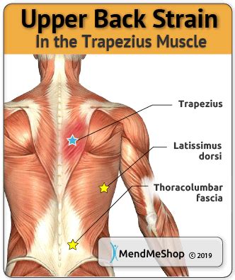 Trapezius Strain