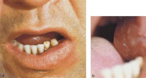 Figure 1 from Mucosal Leishmaniasis Occurring in a Renal Transplant ...