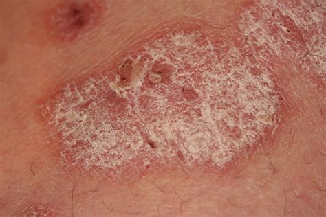 Psoriasis Skin Lesions