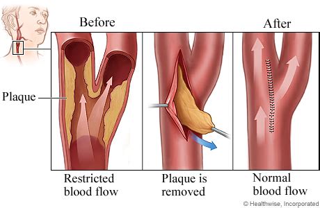 Carotid Endarterectomy | HealthLink BC