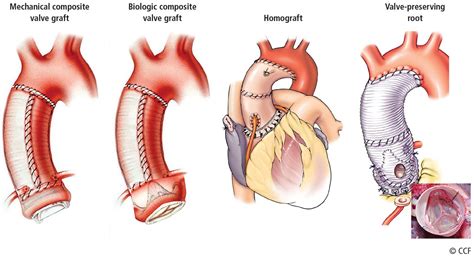 Aortic replacement in cardiac surgery | Cleveland Clinic Journal of ...