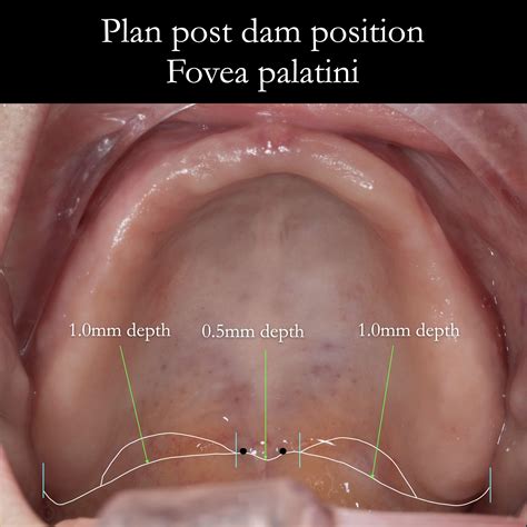 Post dam position for maxillary complete dentures – the fovea palatini ...