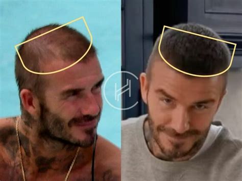 David Beckham Hair Transplant - Hair Loss & Technical Analysis