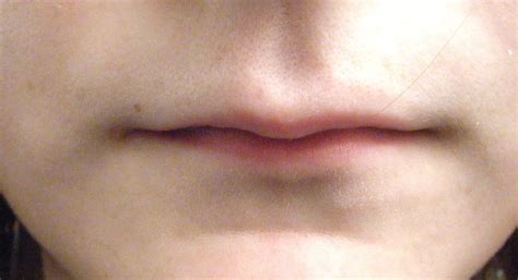 Thin Lips | SG Aesthetics