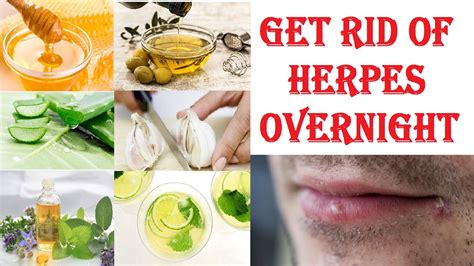 How To Cure Herpes Overnight | Natural Home Remedies For Removal Of ...