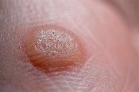 Wart Removal - ProSkin Clinic & Health UK - Gloucester