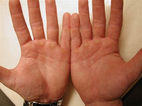 What Causes Lump to Appear in Your Palm? | Med-Health.net