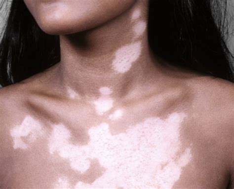 Types of Vitiligo – Global Vitiligo Foundation