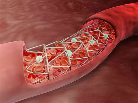 Was ist ein Stent? - MedDe