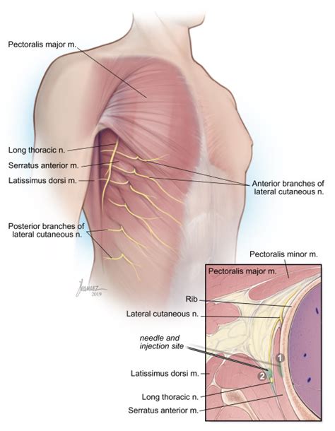 Serratus anterior block | Anesthesia Key