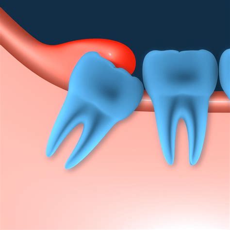 pericoronaritis | Dental EDO