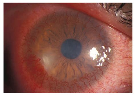 Corneal neovascularization - MEDizzy