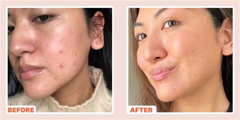 How to Treat Breakouts After Microneedling? – the BEAUTIOUS