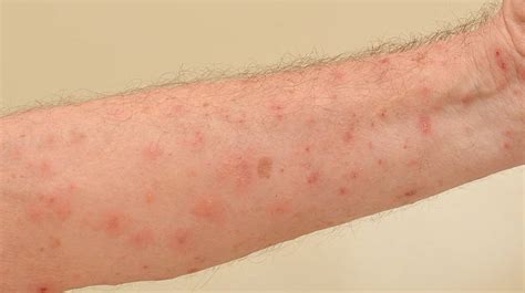 Scabies Rash Schurft Herkennen - Kleine Kwalen In De Huisartsenpraktijk ...