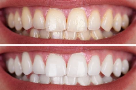 Teeth Whitening in Wilkesboro and Wilkes County Area