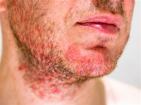 Seborrheic Dermatitis: Causes, Symptoms and Treatment – Balmonds