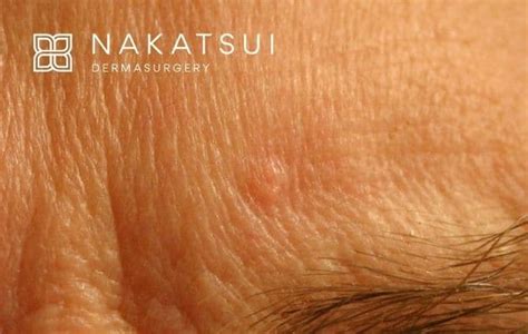 Sebaceous Hyperplasia | Edmonton Dermatology | Nakatsui Dermasurgery