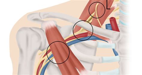 Thoracic Outlet Syndrome - Symptoms, Causes, Treatment and Exercises